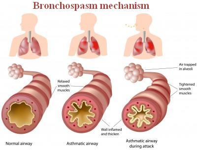 Bronchospasm: Definition, Symptoms, Causes, and Treatment