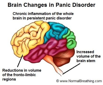 brain changes in panic disorder
