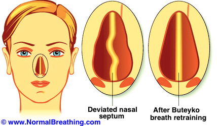 Causes and symptoms-treatment of a deviated septum with Buteyko breathing retraining