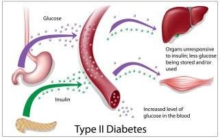 Causes and symptoms of type 2 diabetes: insulin resistance and increased glucose levels