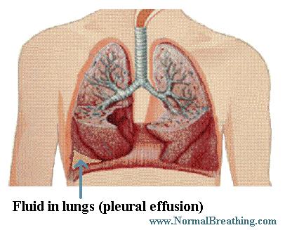 fluid on and in lungs