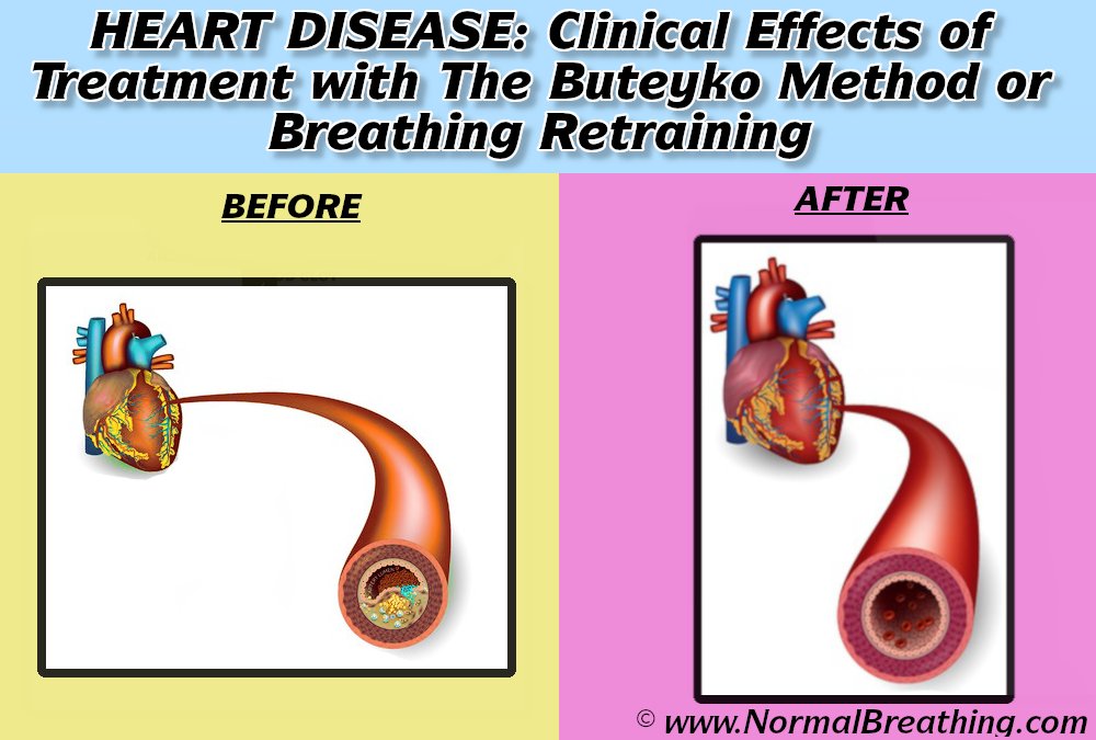 Ischemic heart disease before and after treatment with the Buteyko method or breathing retraining