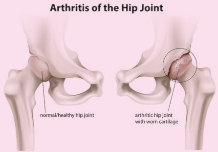 Chronis arthirtis of hip joints of legs