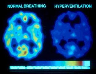 Hyperventilation causes low O2 and headaches