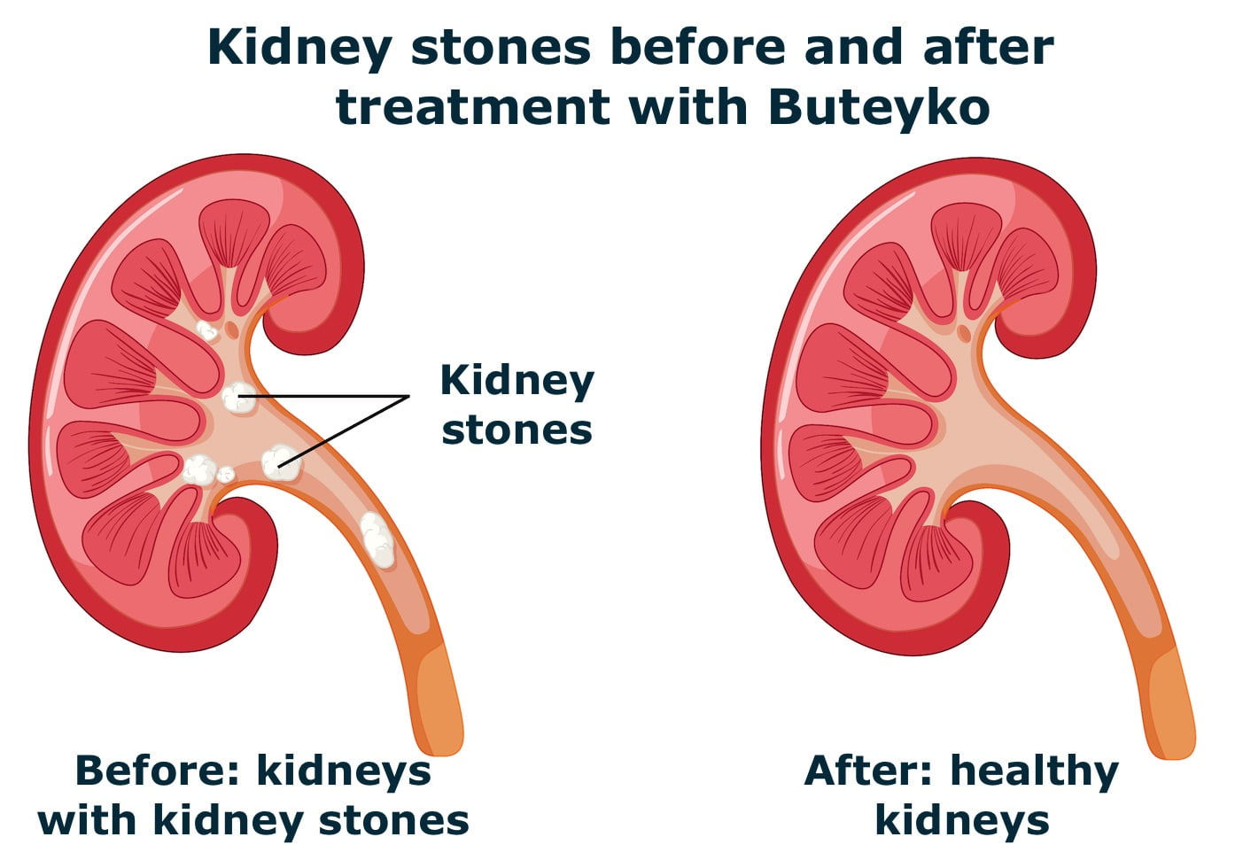 Kidney Stone before and after treatment with the Buteyko method or breathing retraining