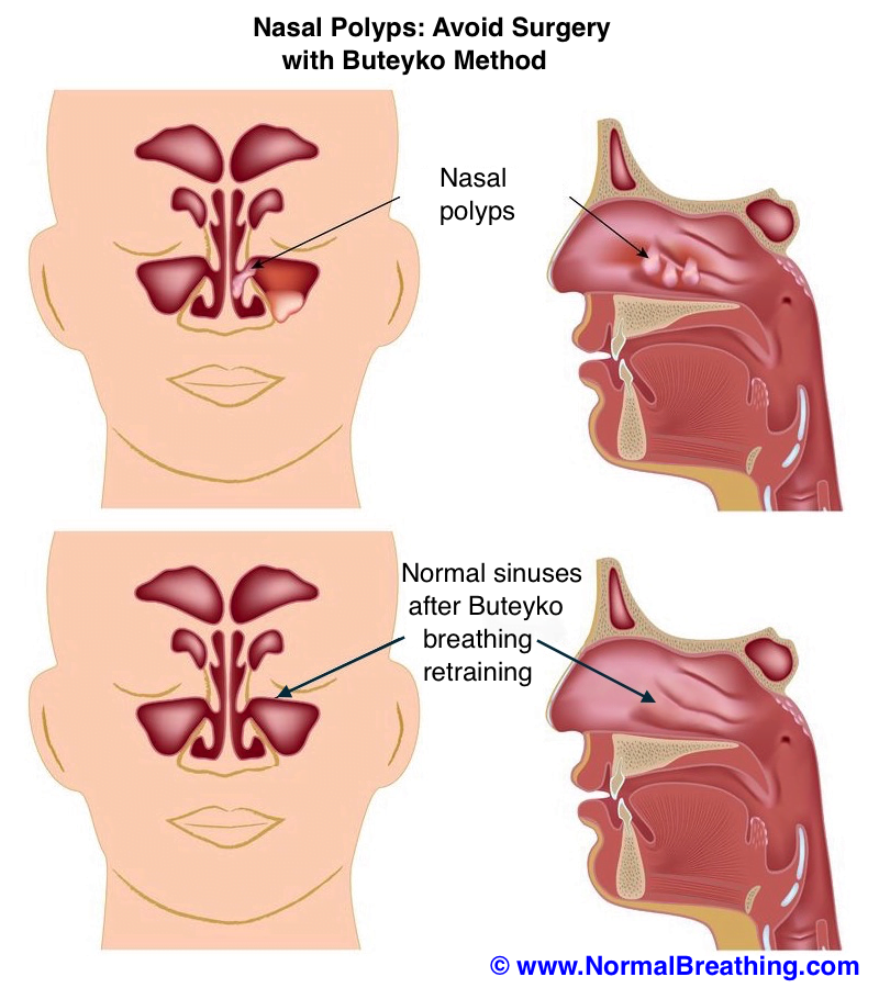 nasal polyps untreated