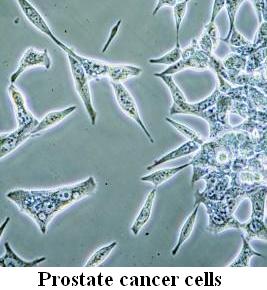 Prostate cancer cells