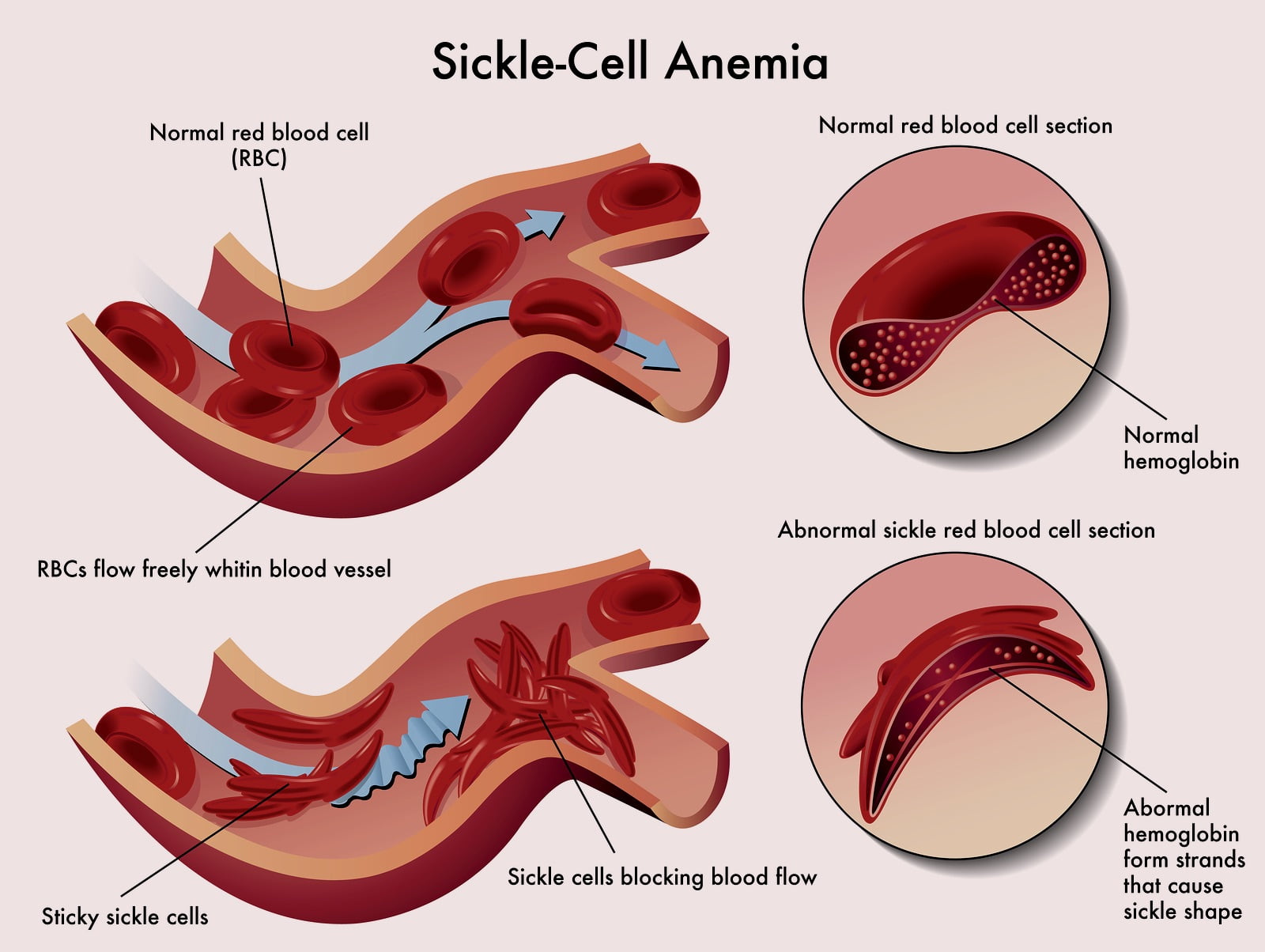 Treat/Cure Sickle Cell Anemia Naturally With Body Oxygen and Breath