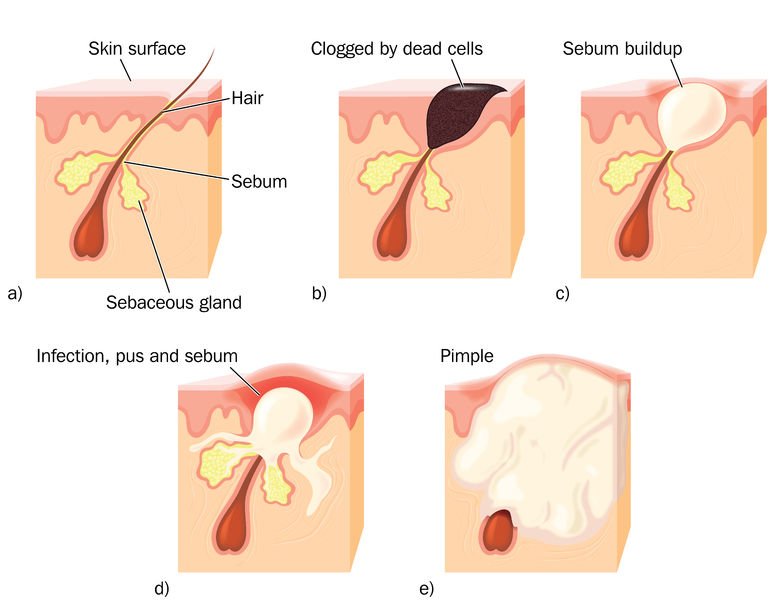 development of acne caused by heavy breathing naturally treated with Buteyko breath retraining